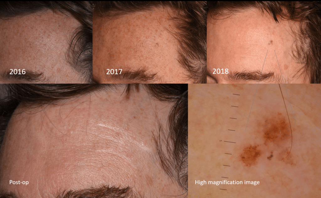 silently growing melanoma