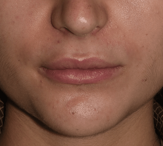 8D lip filler technique after image