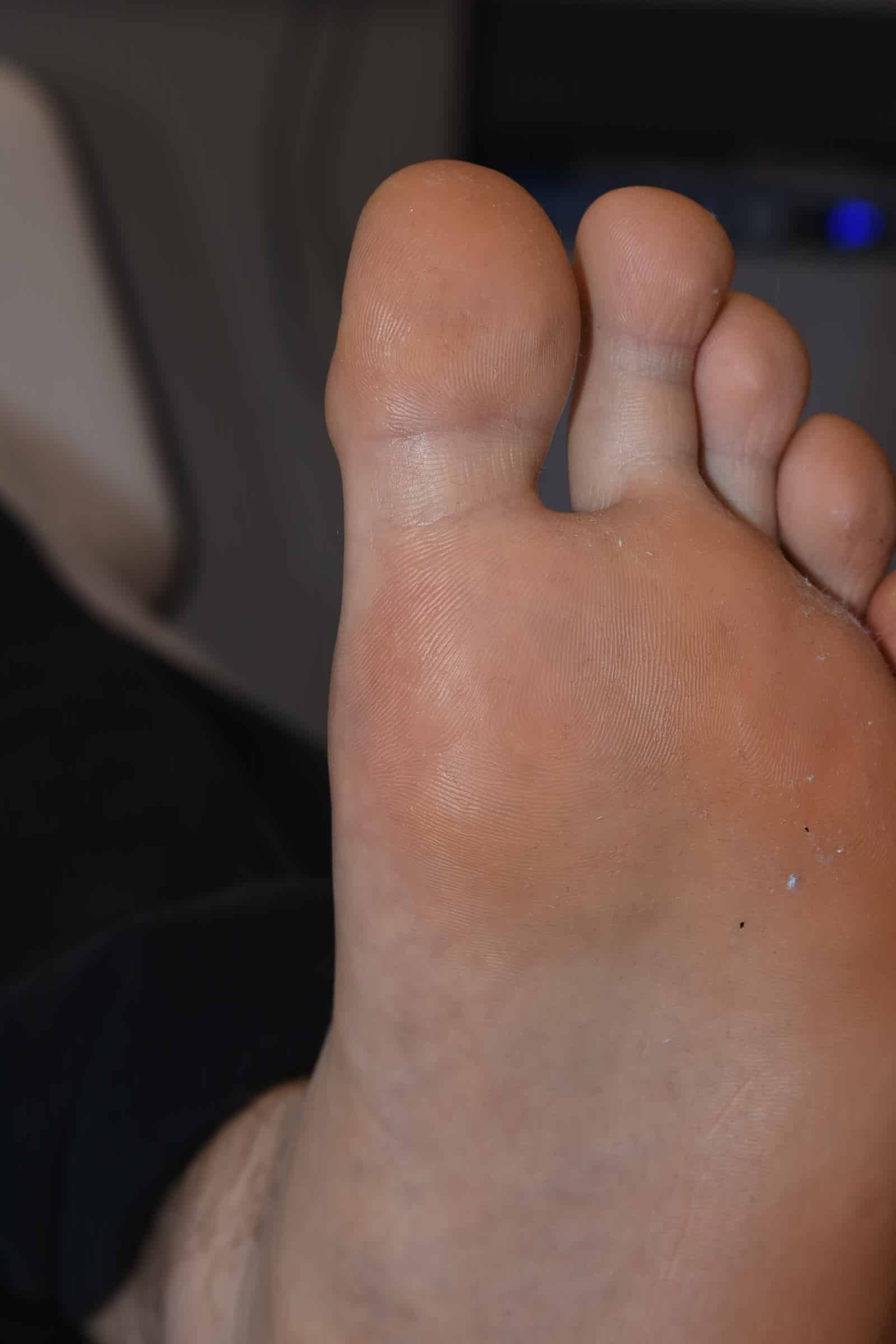 viral wart after cryotherapy