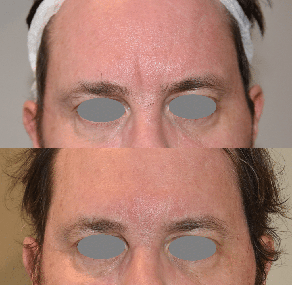 frown line Botox and fillers