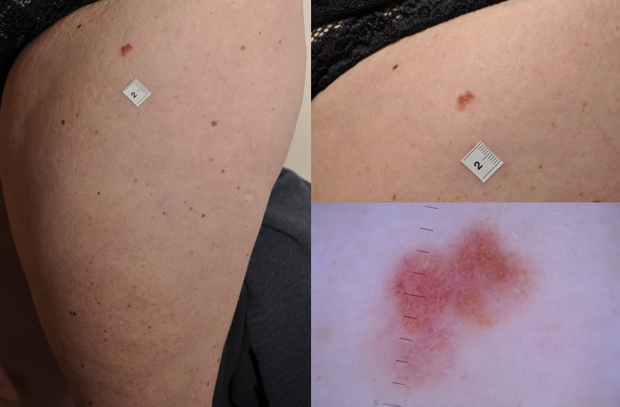 Malignant melanoma - region, close-up and high-magnification images