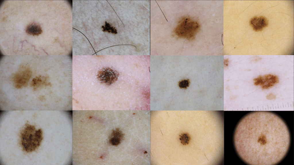 micromelanomas smaller than 5mm