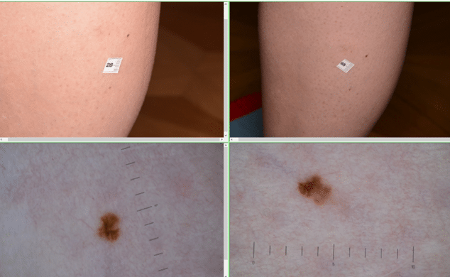Before and after clinical and dermatoscopic images of an in-situ melanoma showing visible changes over time.