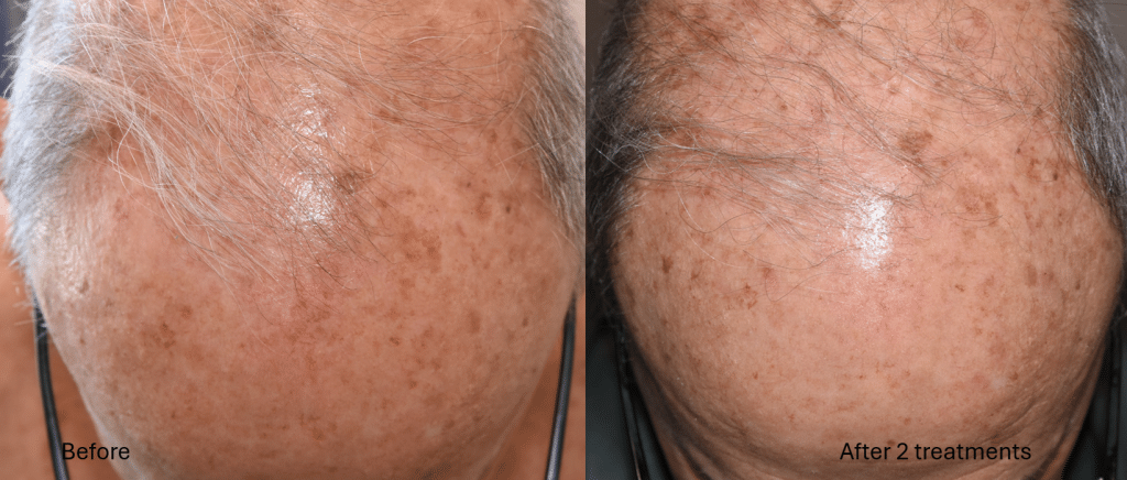 JC D PDT before after