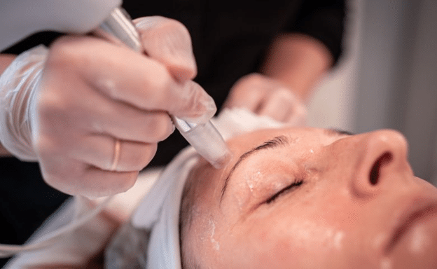 microneedling for scars stretch marks and hair loss