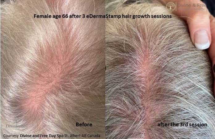 hair growth Dermaroller ba Divine Free a 002