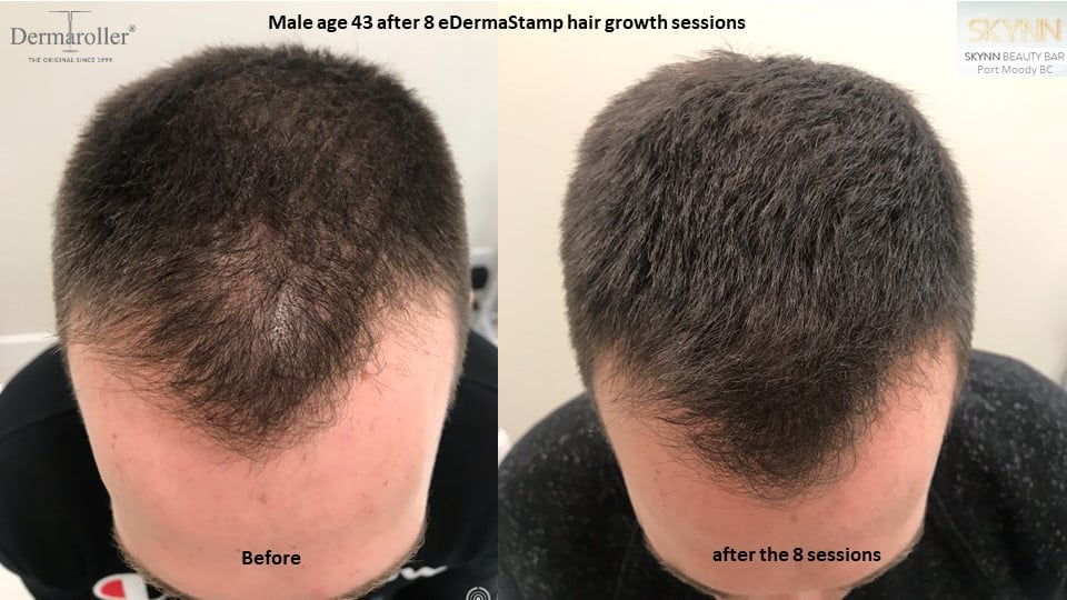 hair growth Dermaroller ba Skynn Port Moody