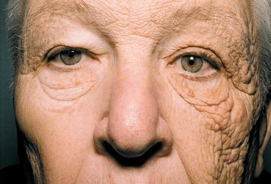 severely sun damaged skin