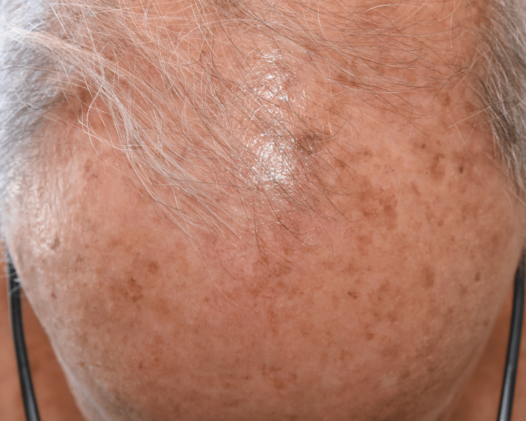 solar keratosis field carinisation