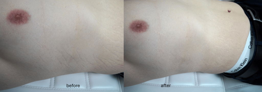 strechmark microneedling before after