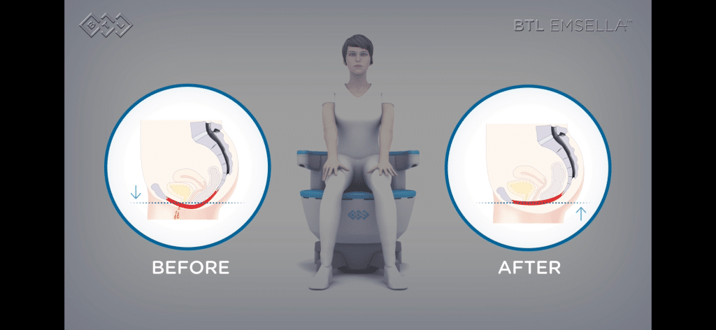 Before-and-after illustration showing how Emsella pelvic floor chair treatment lifts and strengthens the pelvic floor muscles to improve bladder control.