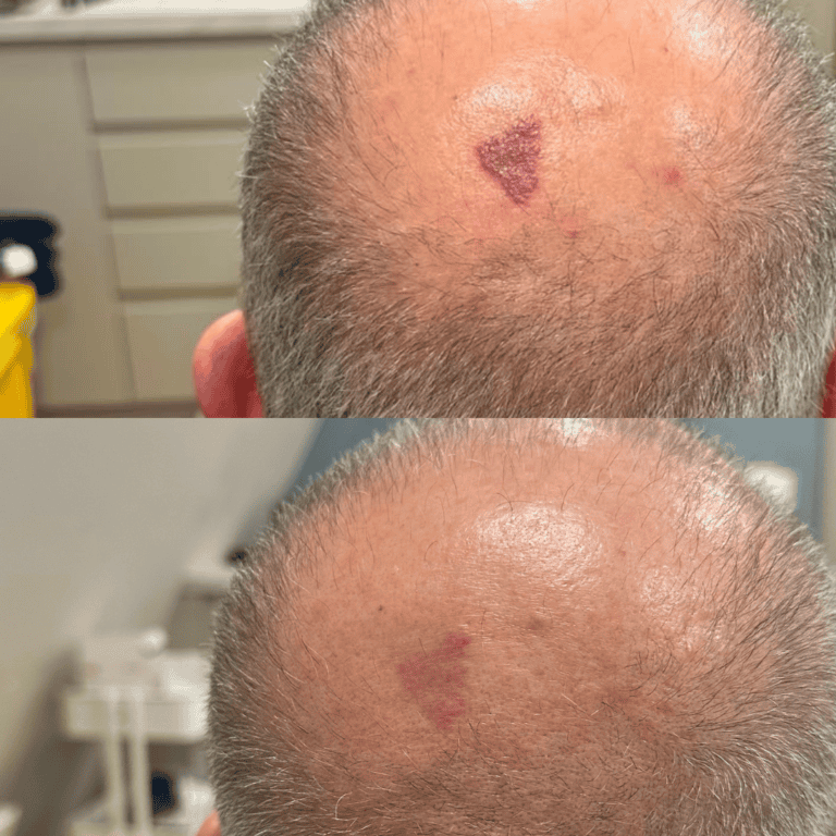 Port Wine Stain Removal