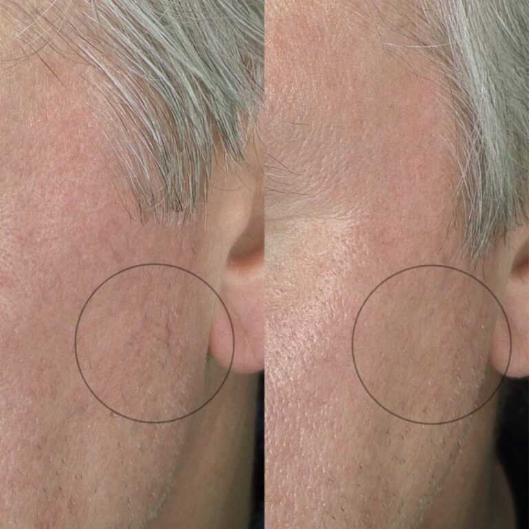 Thread Veins Removal 1